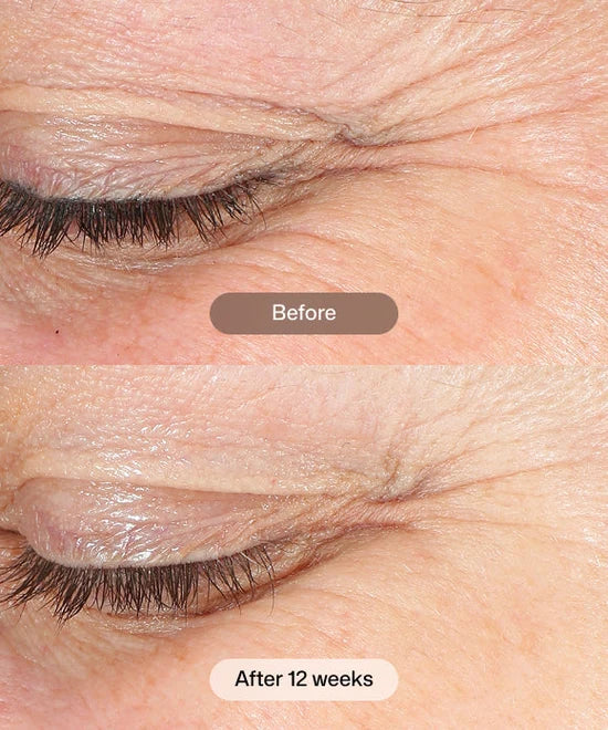 Revox™ Line Relaxer