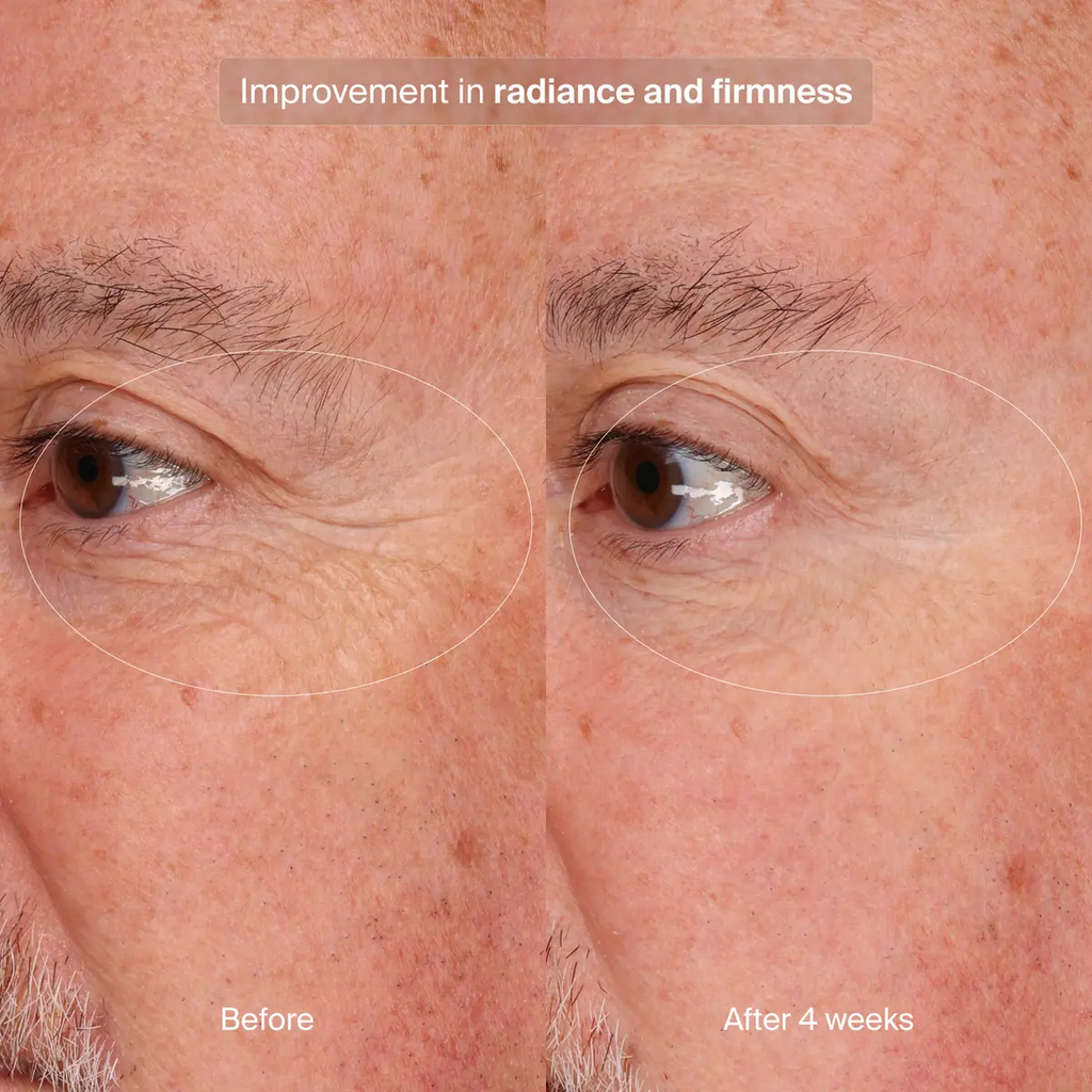 Precision Eye Lift