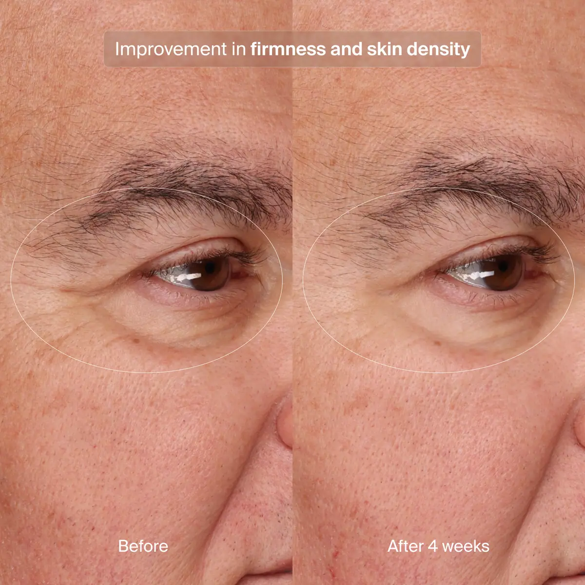 Precision Eye Lift