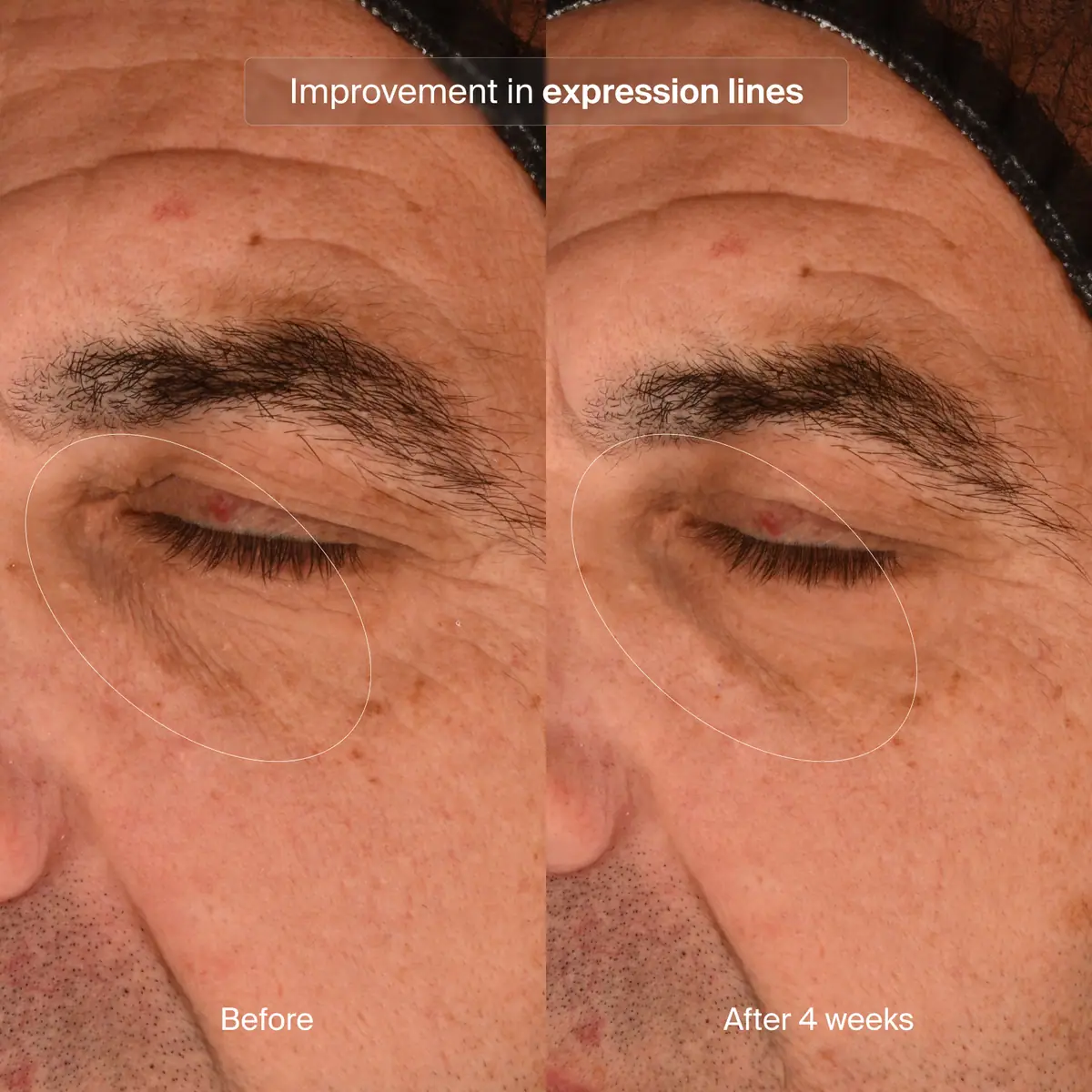 Precision Eye Lift