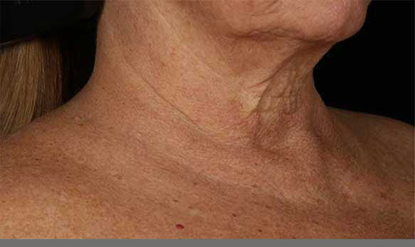 Neck Correct Neck and Décolleté Cream