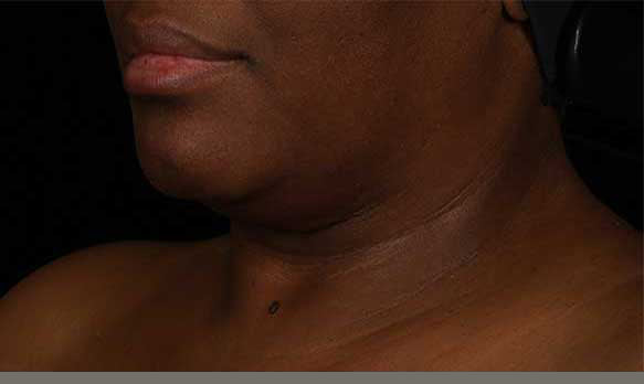 Neck Correct Neck and Décolleté Cream