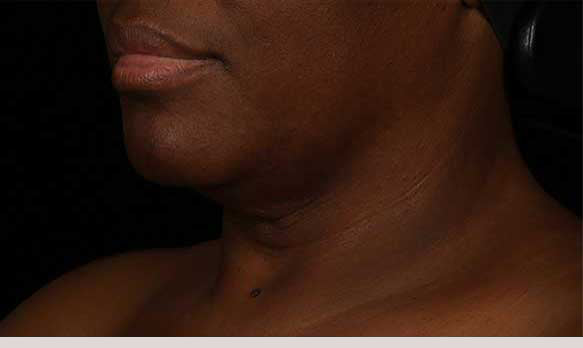 Neck Correct Neck and Décolleté Cream