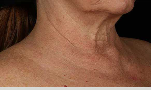 Neck Correct Neck and Décolleté Cream
